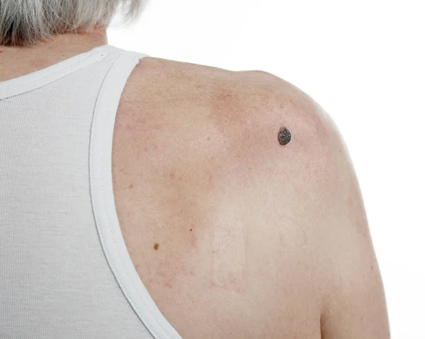 Cancro della pelle negli uomini . — Foto Stock