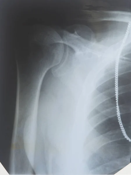 Рентген плечевого сустава — стоковое фото