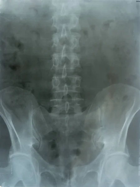 Roentgen of the spine and pelvis — Stock Photo, Image