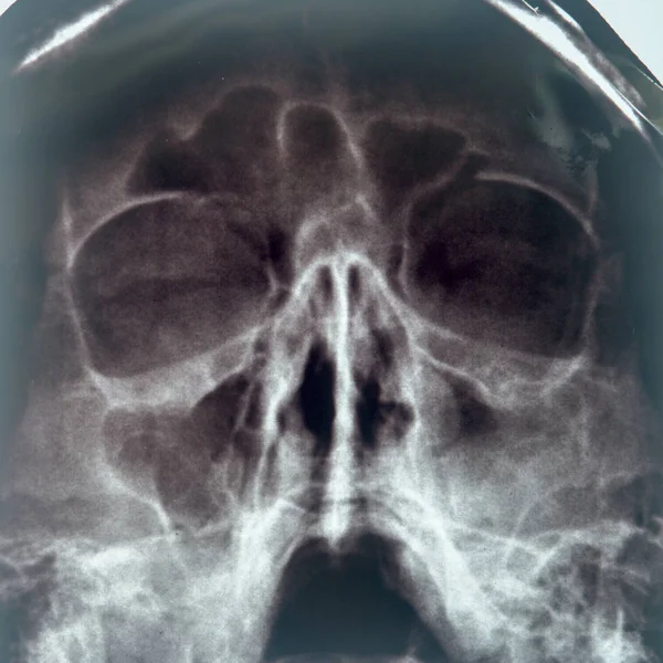 X-ray of the sinuses of the nose — Stock Photo, Image