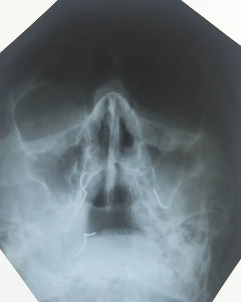 X-ray of the sinuses of the nose — Stock Photo, Image