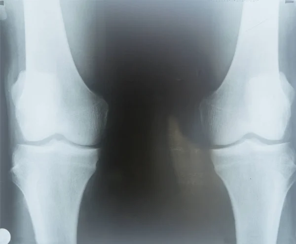 Roentgen of knee joints — Stock Photo, Image