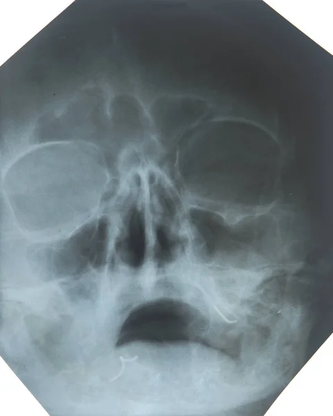 X-ray of the sinuses of the nose — Stock Photo, Image