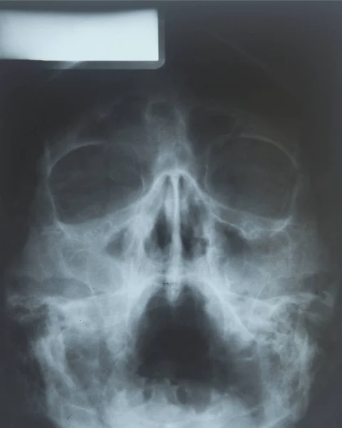 X-ray of the sinuses of the nose — Stock Photo, Image