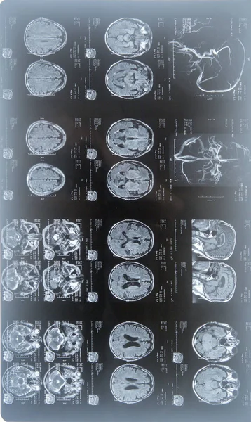 MRI scan of the human brain — Stock Photo, Image