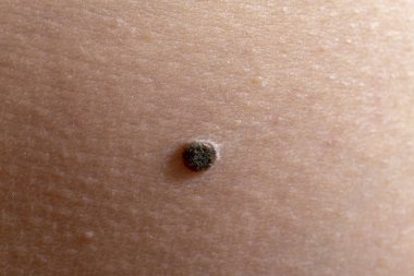 Melanomun ilk aşaması
