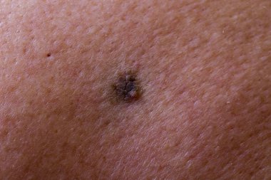 Melanomun ilk aşaması