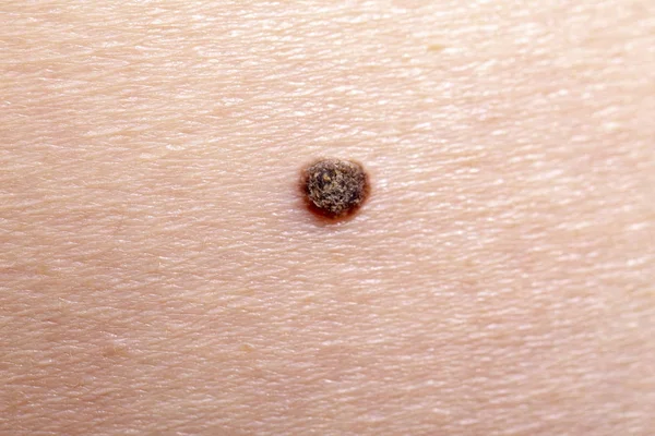 Melanomun ilk aşaması — Stok fotoğraf