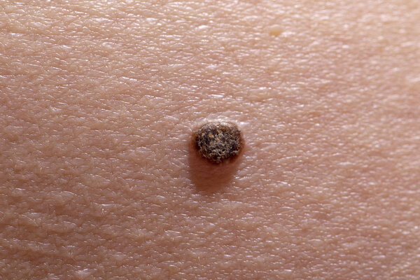The initial stage of melanoma