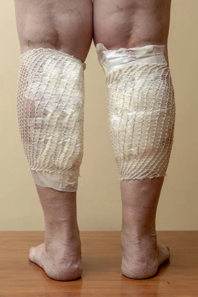 Перевязаны Варикозные Ноги После Лечения Медицинскими Пиявками Лечение Варикозного Расширения — стоковое фото