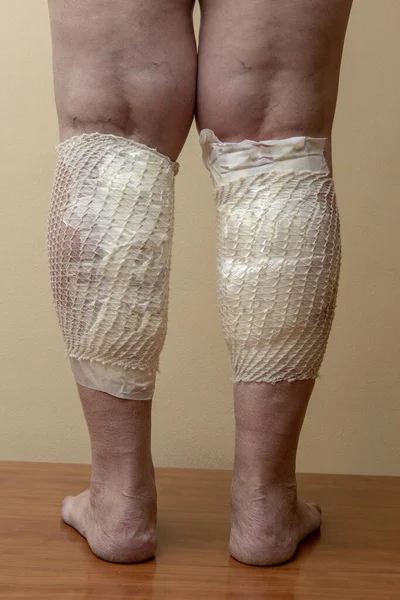Перевязаны Варикозные Ноги После Лечения Медицинскими Пиявками Лечение Варикозного Расширения — стоковое фото