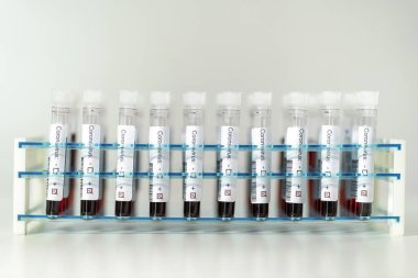 Corona virüsü testlerinin pozitif sonuçları. Laboratuvarda özel tutucuda bir sürü kan testi tüpü var..