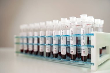 Corona virüsü testlerinin pozitif sonuçları. Laboratuvarda özel tutucuda bir sürü kan testi tüpü var..