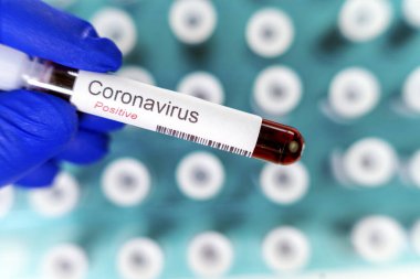 Sağlık çalışanı, korona virüsü testinin pozitif sonuçlarını gösteren bir test tüpü tutuyor. Arka plan olarak özel tutucuda birçok kan tüpü testi.