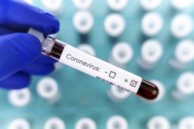 Sağlık çalışanı, korona virüsü testinin pozitif sonuçlarını gösteren bir test tüpü tutuyor. Arka plan olarak özel tutucuda birçok kan tüpü testi.