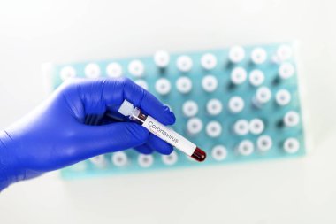 Sağlık çalışanı, korona virüsü testinin pozitif sonuçlarını gösteren bir test tüpü tutuyor. Arka plan olarak özel tutucuda birçok kan tüpü testi.
