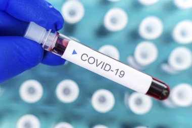 Corona virüsü testlerinin pozitif sonuçları. Laboratuvarda özel tutucuda bir sürü kan testi tüpü var..