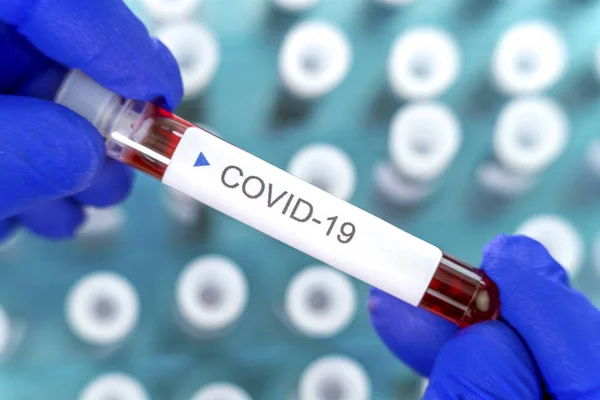 Positive Ergebnisse Von Coronavirus Tests Viele Blutproben Speziellen Halter Labor Stockbild