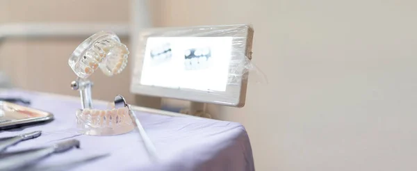Voorbeeld Implantaat Valse Tanden Monitor Ray Apparatuur Tandheelkundige Kliniek — Stockfoto