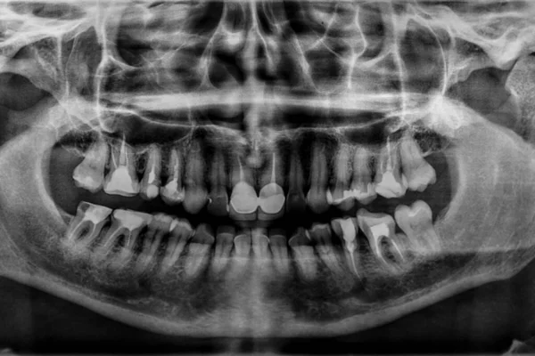 Radiografia Dentale Panoramica Una Bocca Con Molte Otturazioni Dentali Denti — Foto Stock