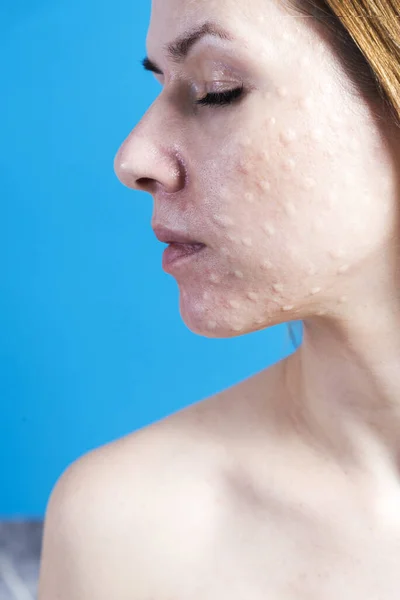 Biorvitalização da pele real. Vestígios de injeções de biorevitalização em uma cara de mulher — Fotografia de Stock