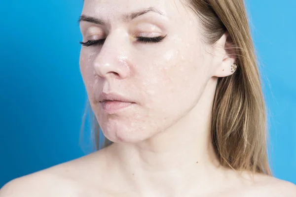 Biorevitalization of real skin. Traces of biorevitalization injections on a womans face — Stock Photo, Image