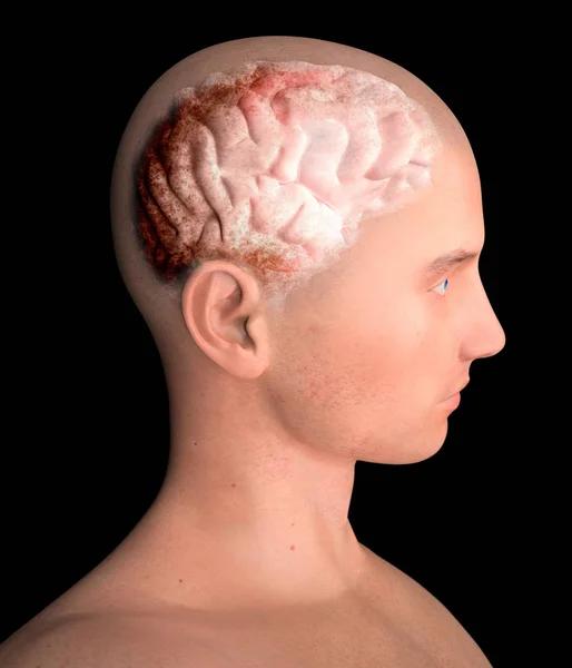 Мозг, дегенеративные заболевания, Паркинсон, человеческое тело, лицо — стоковое фото