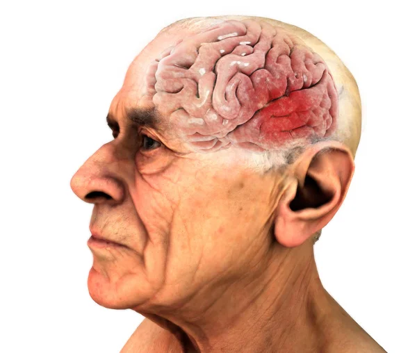 Cerebro, enfermedades degenerativas, Alzheimer, Parkinson, cuerpo humano, cara. Viejo. —  Fotos de Stock
