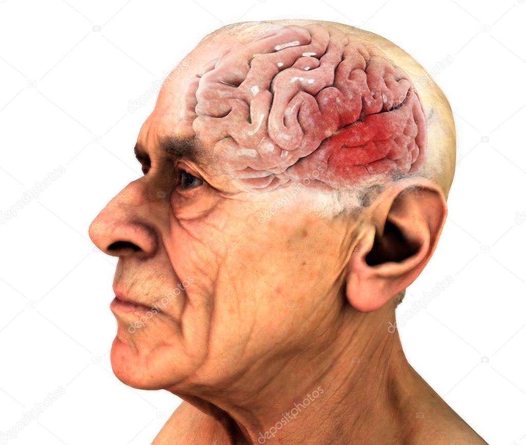 Brain, Degenerative Diseases, Alzheimer's, Parkinson's, Human Body, Face. Old man