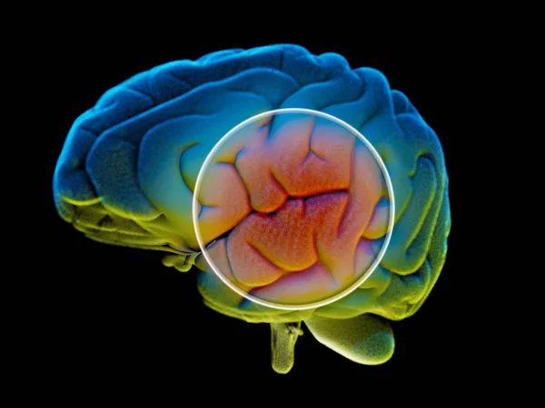 Doenças Degenerativas Cérebro Parkinson Sinapses Neurônios Alzheimer Renderização — Fotografia de Stock