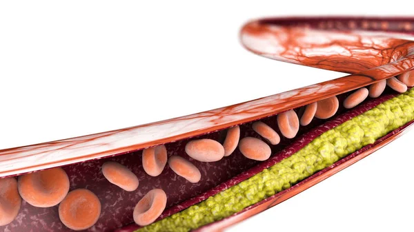 Χοληστερόλη Σχηματισμό Λίπους Αρτηρία Φλέβα Κόκκινο Κύτταρο Αίματος — Φωτογραφία Αρχείου