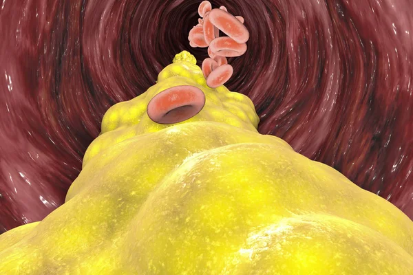 Powstawaniu Cholesterolu Tłuszcz Tętnicy Żyły Serce Zwężenie Żył Dla Formacji — Zdjęcie stockowe