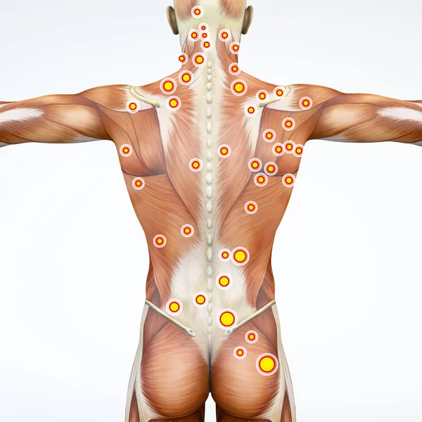 Вид Сзади Человека Триггерные Точки Анатомические Мышцы Рендеринг Миофасциальные Триггерные — стоковое фото