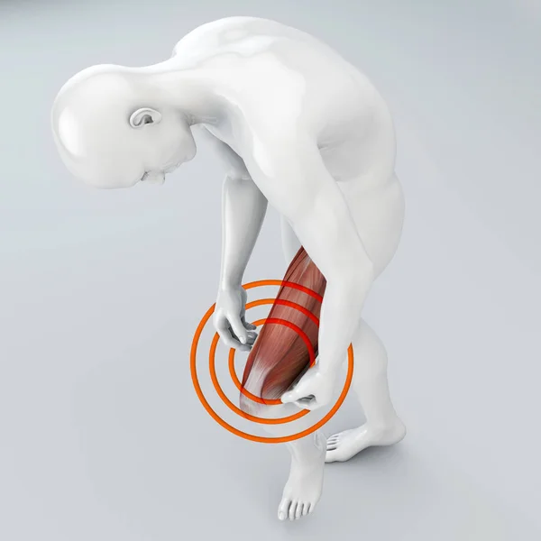 Разрыв Мышц Мышцы Бедра Выше Колена Боль Ноге Связках Человеческое — стоковое фото