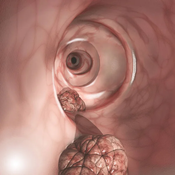 Internal View Intestinal Walls Colorectal Cancer Crc Bowel Cancer Colon — Stock Photo, Image