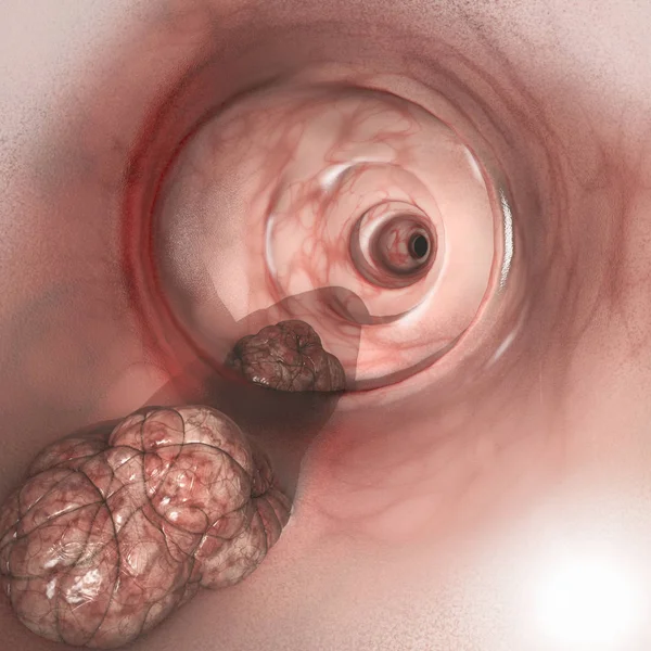 Vue Intérieure Des Parois Intestinales Cancer Colorectal Crc Cancer Intestin — Photo