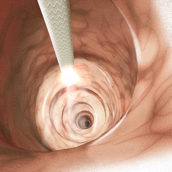 肠壁的内视 结直肠癌 Crc 结肠癌或直肠癌 侵入或扩散到身体其他部位的细胞的异常生长 3D渲染 — 图库照片