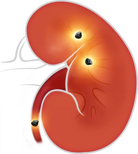 腎臓の人体図 腎臓は脊椎動物に見られる2つの豆型の臓器です 腎臓結石 — ストック写真