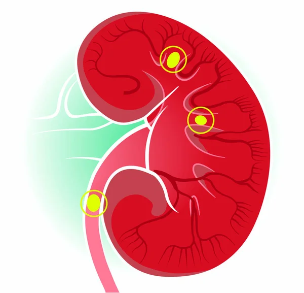 腎臓の人体図 腎臓は脊椎動物に見られる2つの豆型の臓器です 腎臓結石 — ストックベクタ