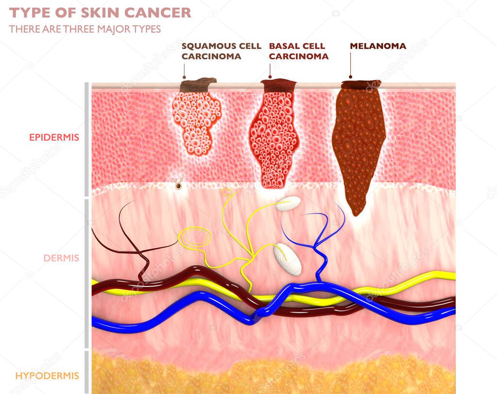Skin tumors, moles and spots, 3d section of the skin layer.Three types of skin cancer, squamous cell carcinoma, basal cell carcinoma, melanoma. 3d render