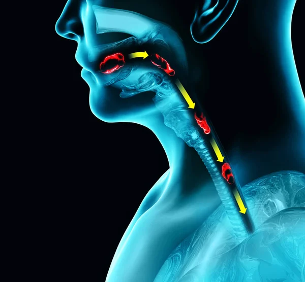 Gangguan Menelan Dysphagia Pharyngeal Dan Disfagi Esofagus Fase Oral Jalan — Stok Foto