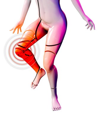 Osteogenez eksikliği, kırılgan kemik hastalığı, çoğunlukla kemikleri etkileyen genetik bozukluklardan oluşan bir gruptur. Kolayca kırılan kemiklerle sonuçlanır. Dizkapağı kırığı. Kritik bağ dokusu. 3d hazırlayıcı