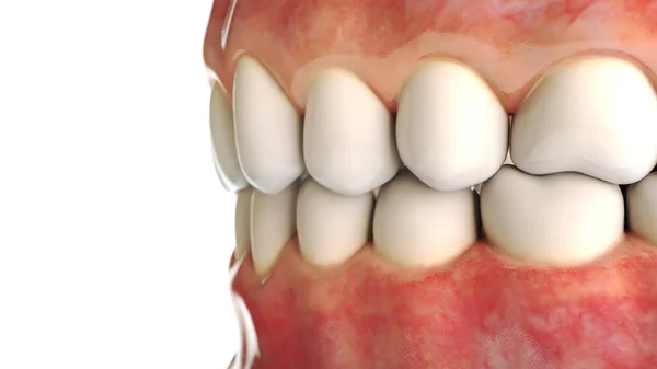 Implante dental invisible sobre fondo blanco - 3D Rendering —  Fotos de Stock