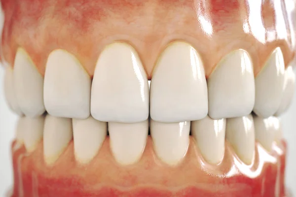 Implante dental invisible sobre fondo blanco - 3D Rendering — Foto de Stock