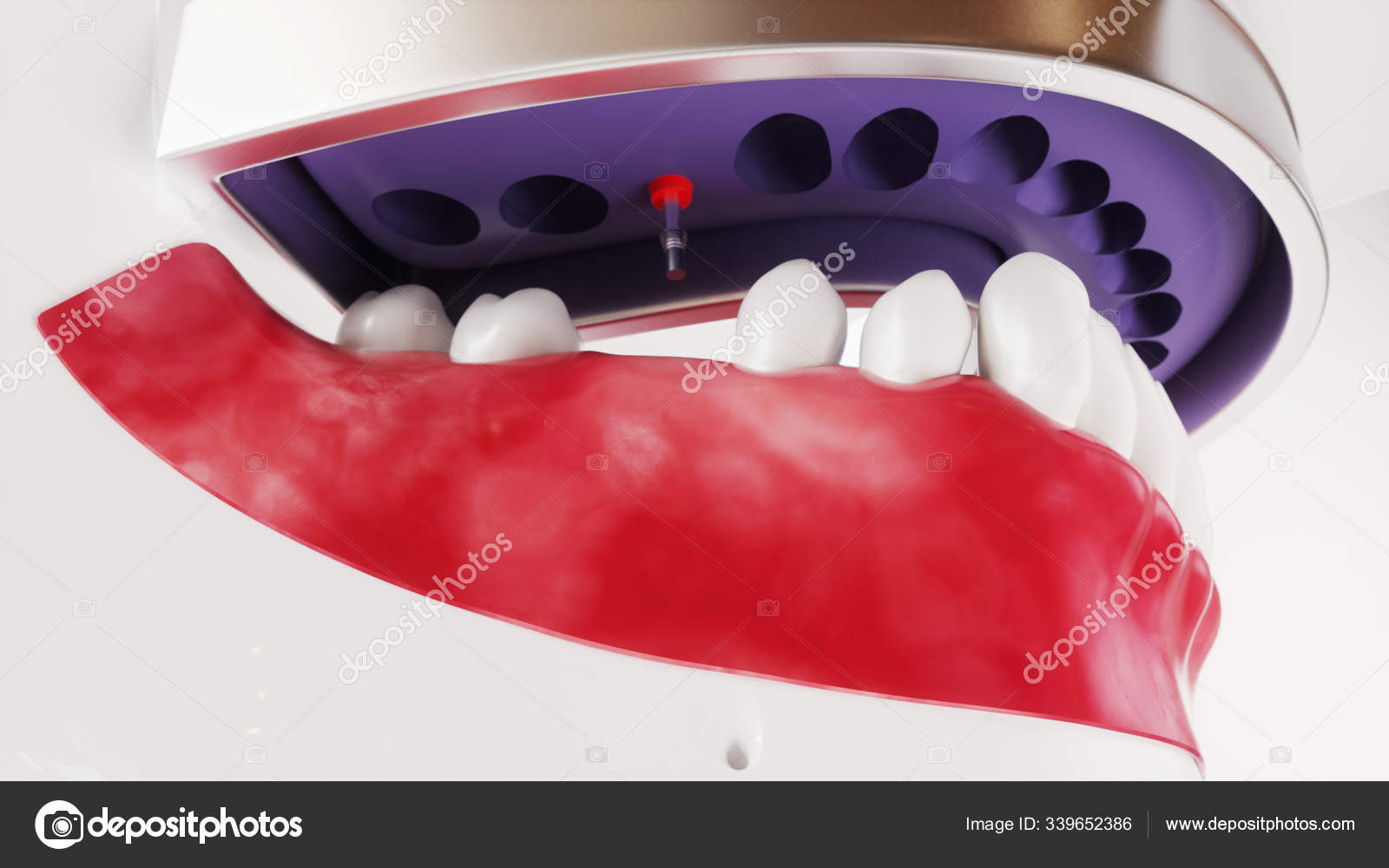 Tooth Implantation Picture Series 10 Of 13 3D Rendering Stock Photo tooth-implantation-picture-series-10-of-13-3d-rendering-stock-photo