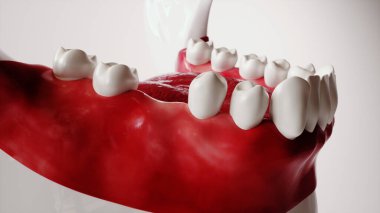 Diş yerleştirme resim serisi 1 / 13 - 3d Hazırlama