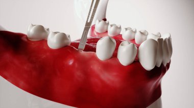 Diş yerleştirme resim serisi 2 / 13 - 3d Hazırlama