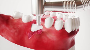 Tooth implantation picture series 5 of 13 - 3D Rendering clipart