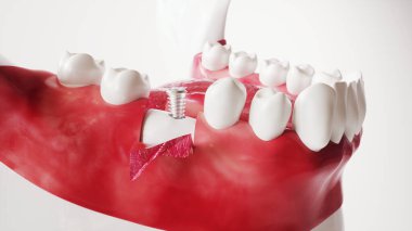 Tooth implantation picture series 6 of 13 - 3D Rendering clipart