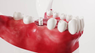 Diş implantasyonu resim serisi 11 / 13 - 3d Hazırlama